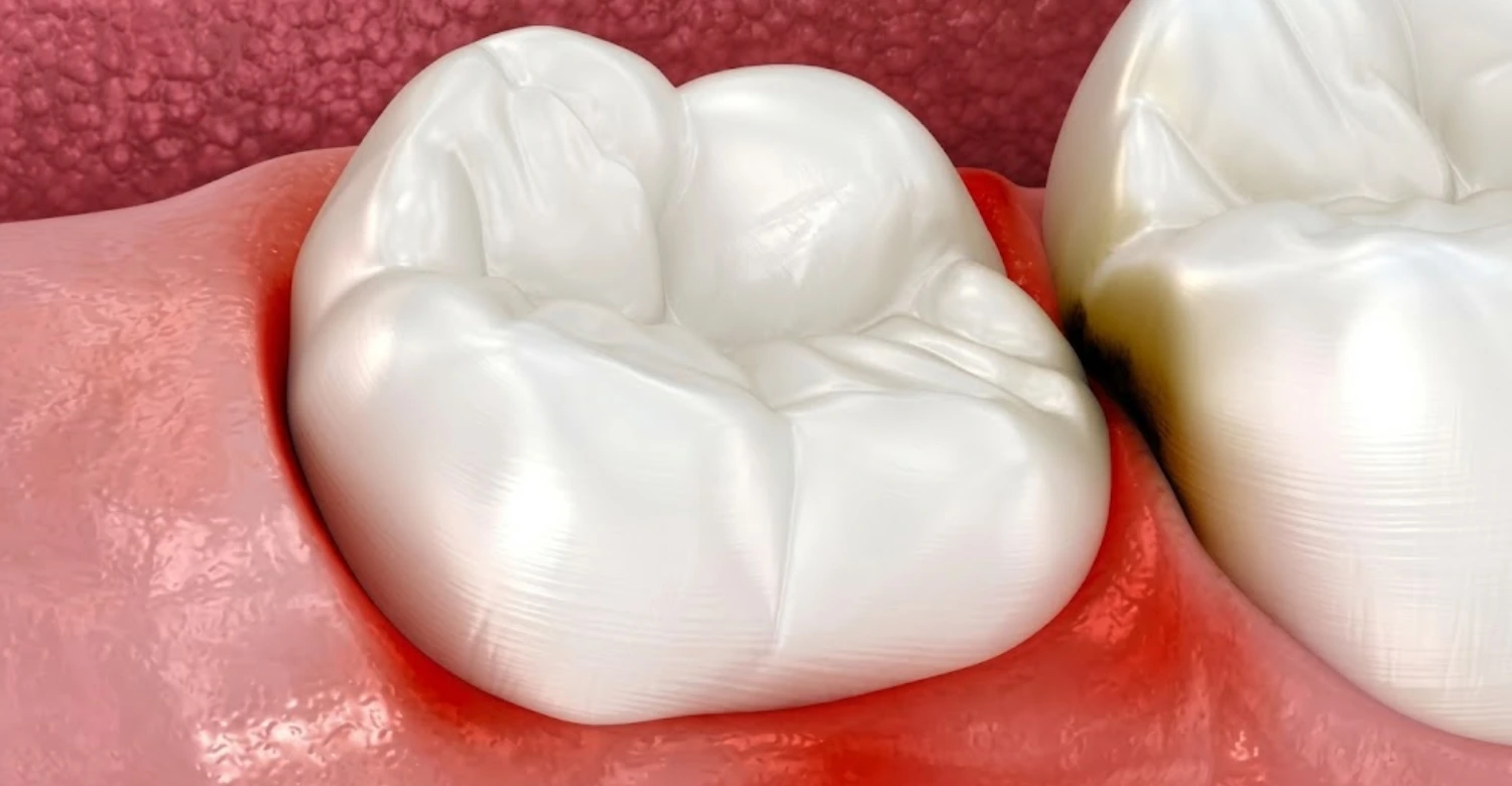 Gum Disease Medication inblog